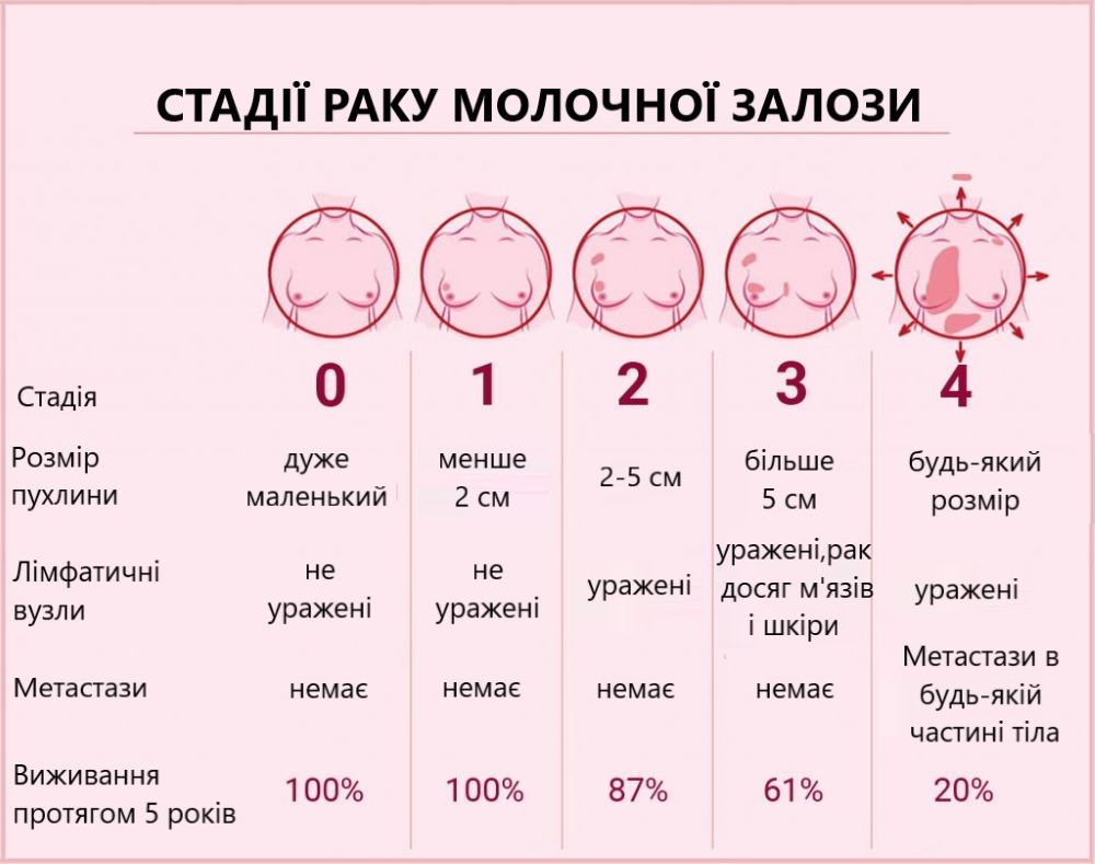 Стадии рака молочной железы