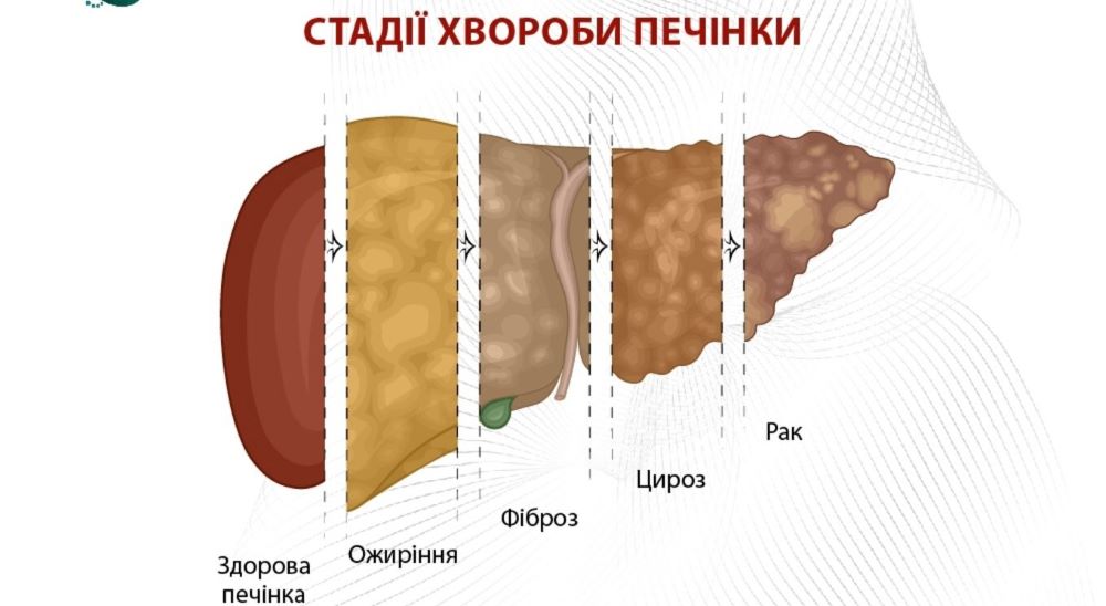 стадии стеатоза