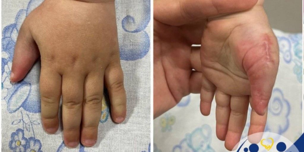 Хірурги успішно видалили зайвий палець.