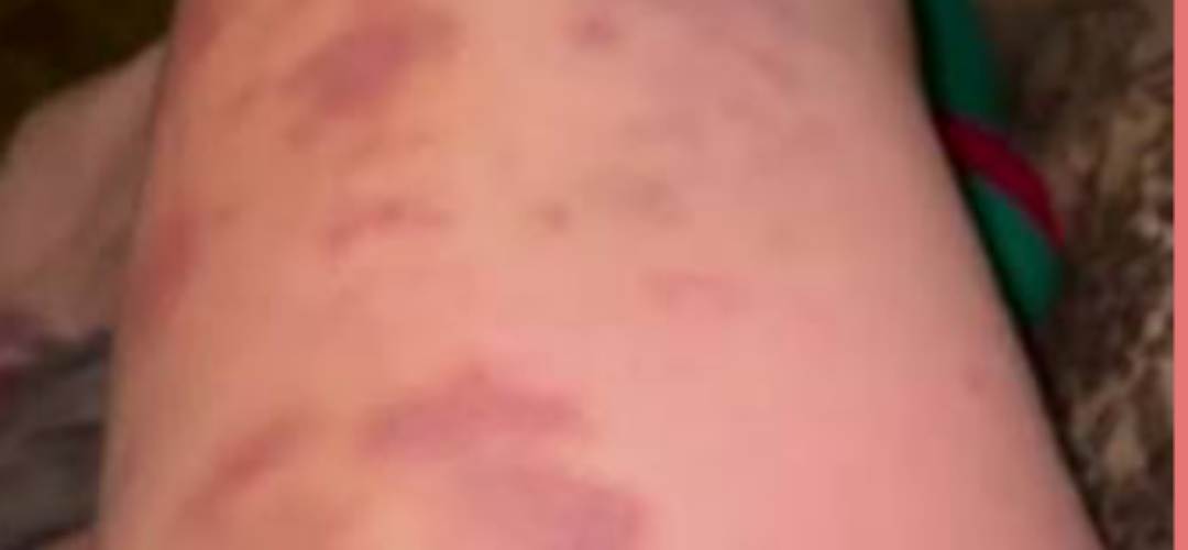 Синці без причини на ногах 