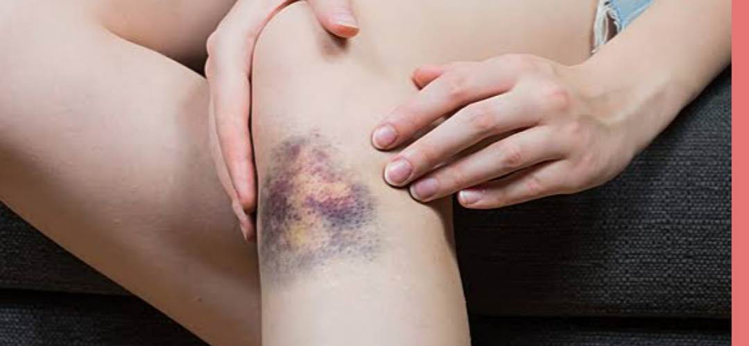 Синяки при лейкозе