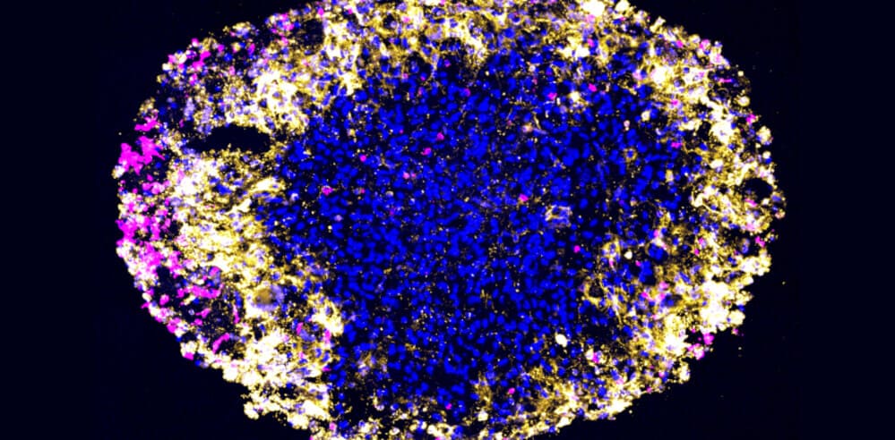 Органоид глиобластомы