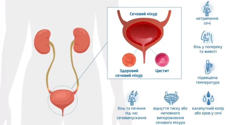 Первые признаки цистита
